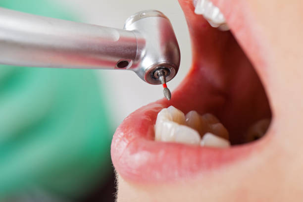 Best Broken or Chipped Tooth Repair in Lakewood, OH